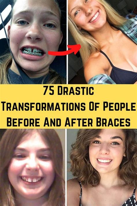 1 month braces transformation|75 drastic transformations of people before and after .